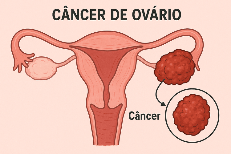 Câncer de Ovário